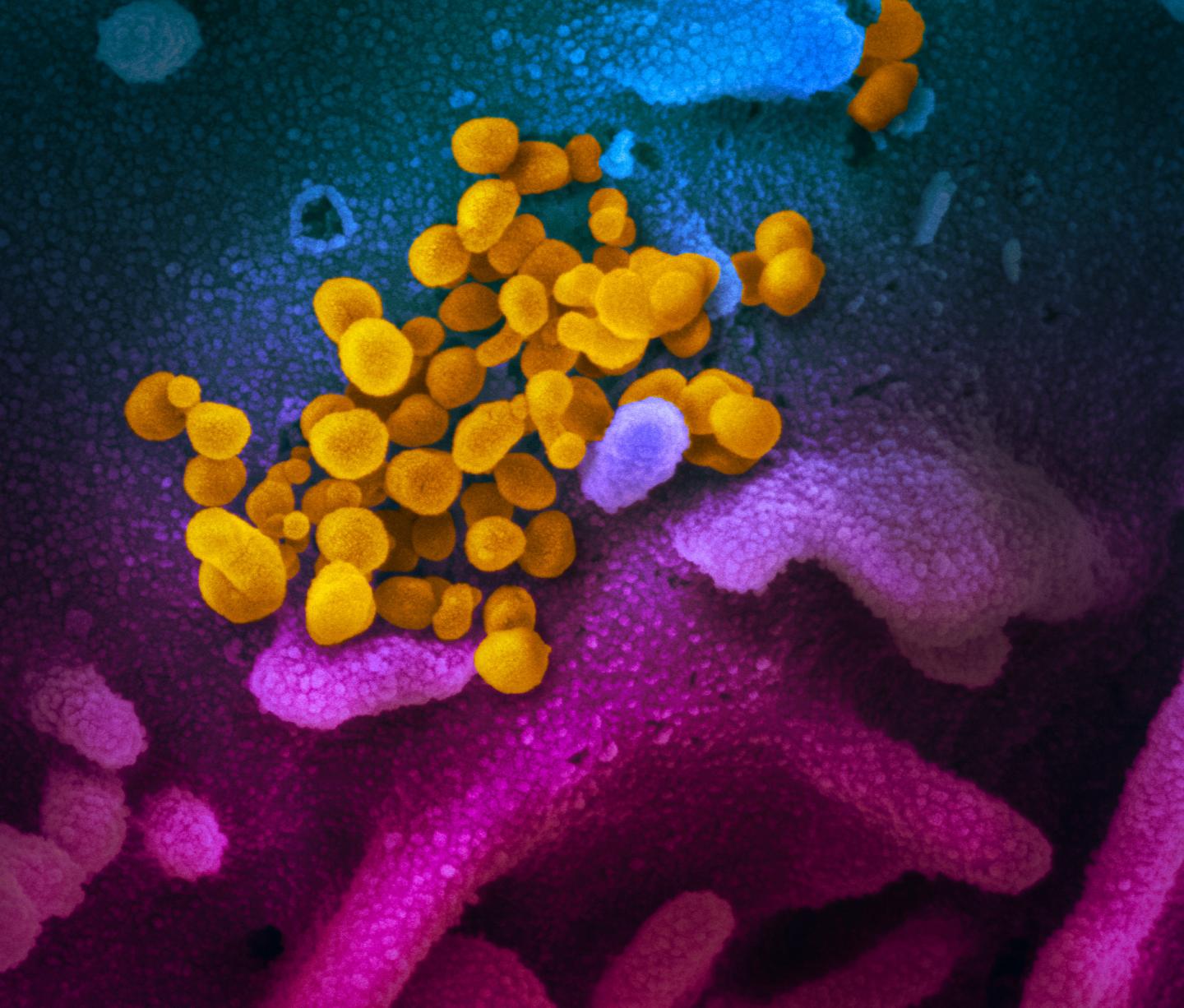 This scanning electron microscope image shows SARS-CoV-2 (yellow)--also known as 2019-nCoV, the virus that causes COVID-19--isolated from a patient in the U.S., emerging from the surface of cells (blue/pink) cultured in the lab